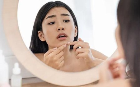 Cara Menghilangkan Jerawat dan Bekasnya