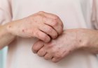 Kasus Mpox Meningkat, Kemenkes Diminta Segera Aktifkan Early Warning Sistem