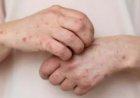 DPR Ingatkan Pemerintah Mpox Agar Jangan Sampai jadi Pandemi