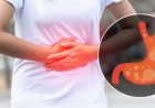 7 Rekomendasi Obat Paling Ampuh Atasi Asam Lambung yang Dijual di Apotek