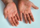 Amerika Konfirmasi Kasus Pertama Varian Baru Mpox