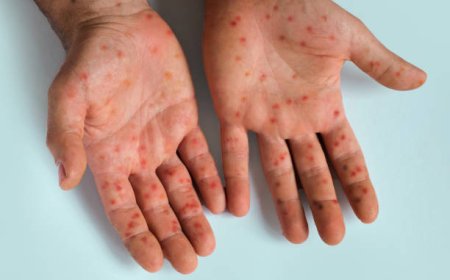 Amerika Konfirmasi Kasus Pertama Varian Baru Mpox