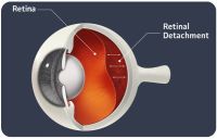 Ablasi Retina: Gejala Awal hingga Kebiasaan Sepele yang Bisa Picu Kebutaan Mendadak